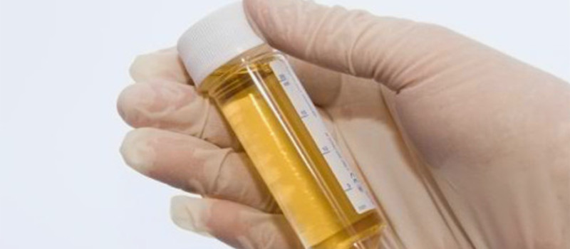 kidney stone disease 1